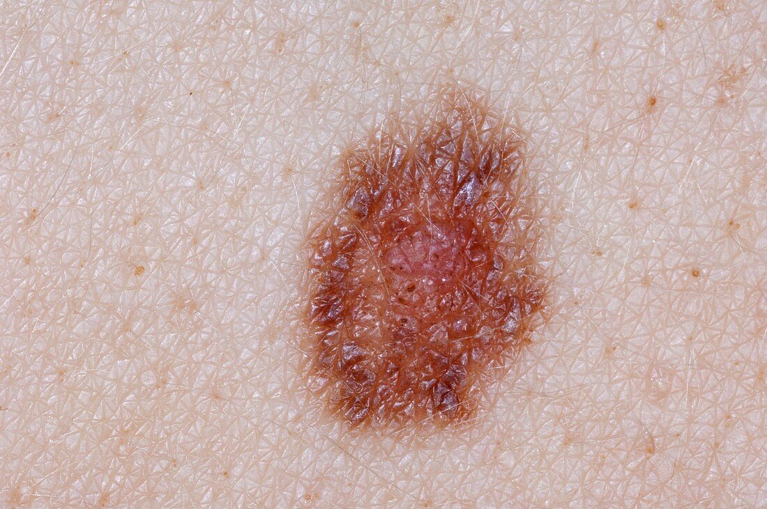 Compound naevus (mole) on the skin
