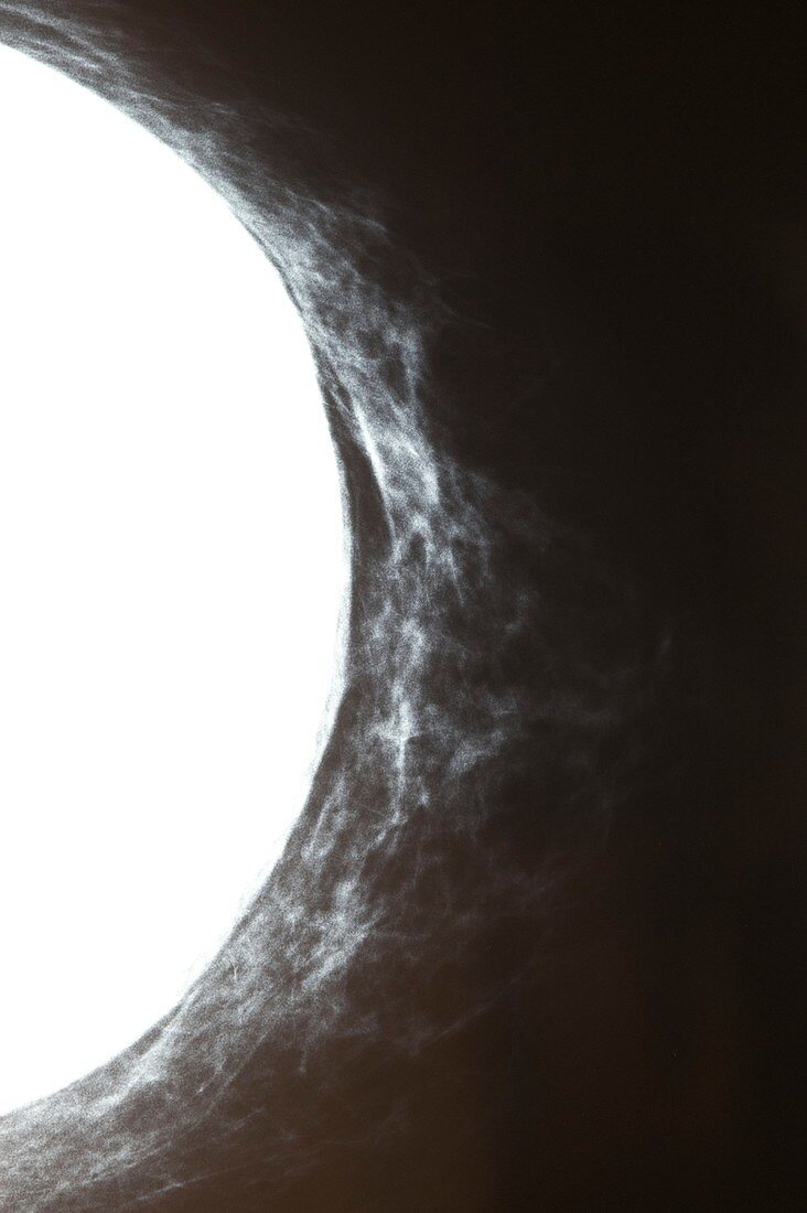 Breast implant,X-ray mammogram