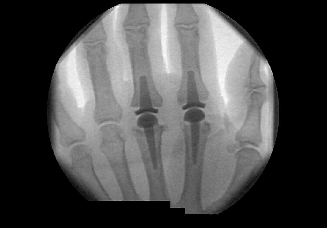 Finger joint replacement,X-ray