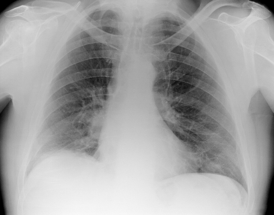 Lung cancer in smoker,X-ray