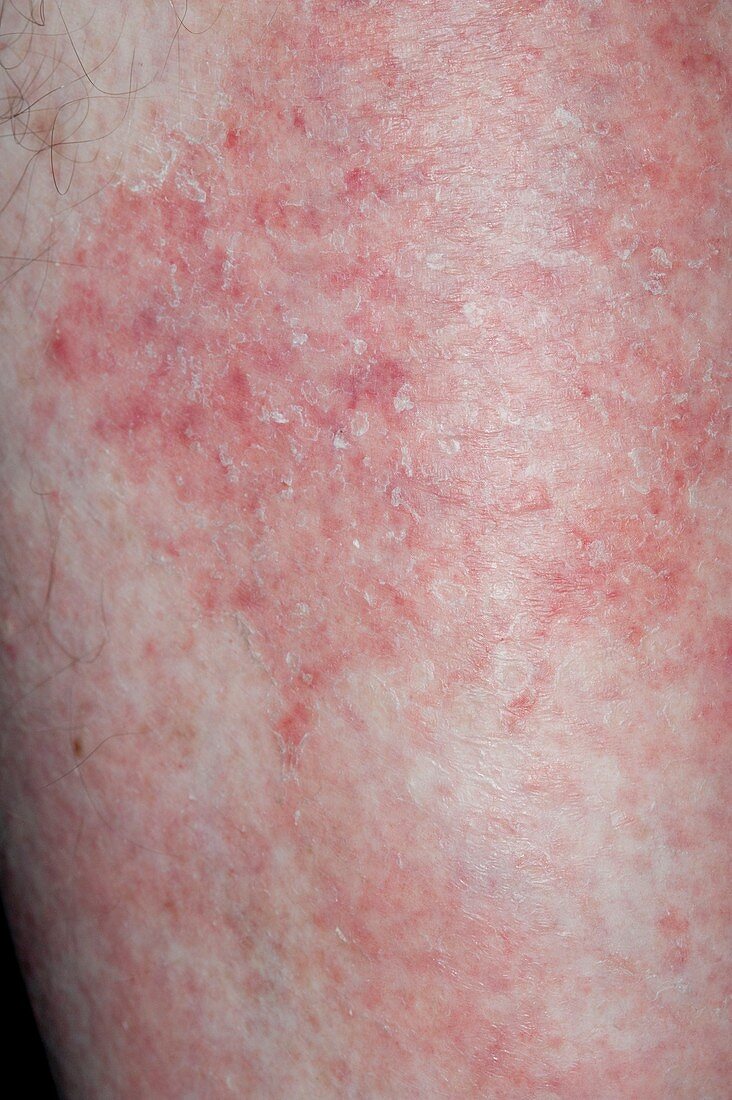Skin in Mycosis fungoides