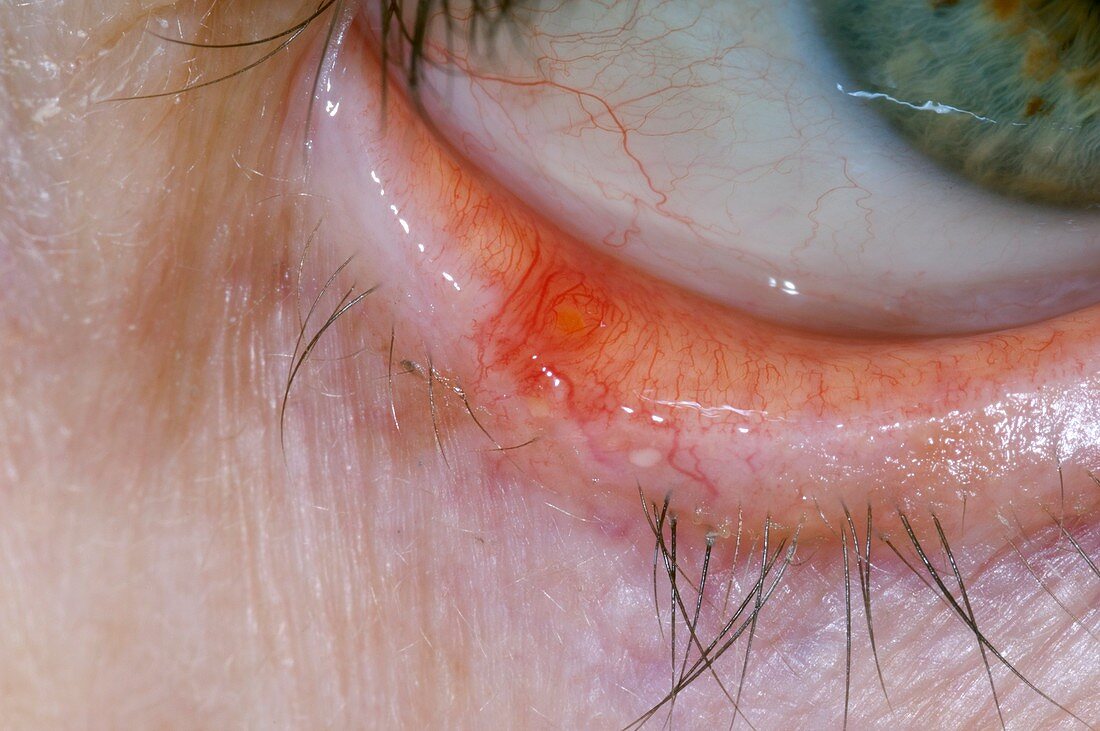 Lesion on the lower eyelid