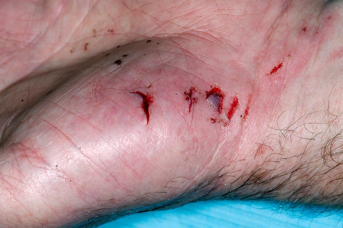 Hand lacerations from dog bites