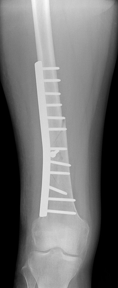 Pinned femur fracture,X-ray