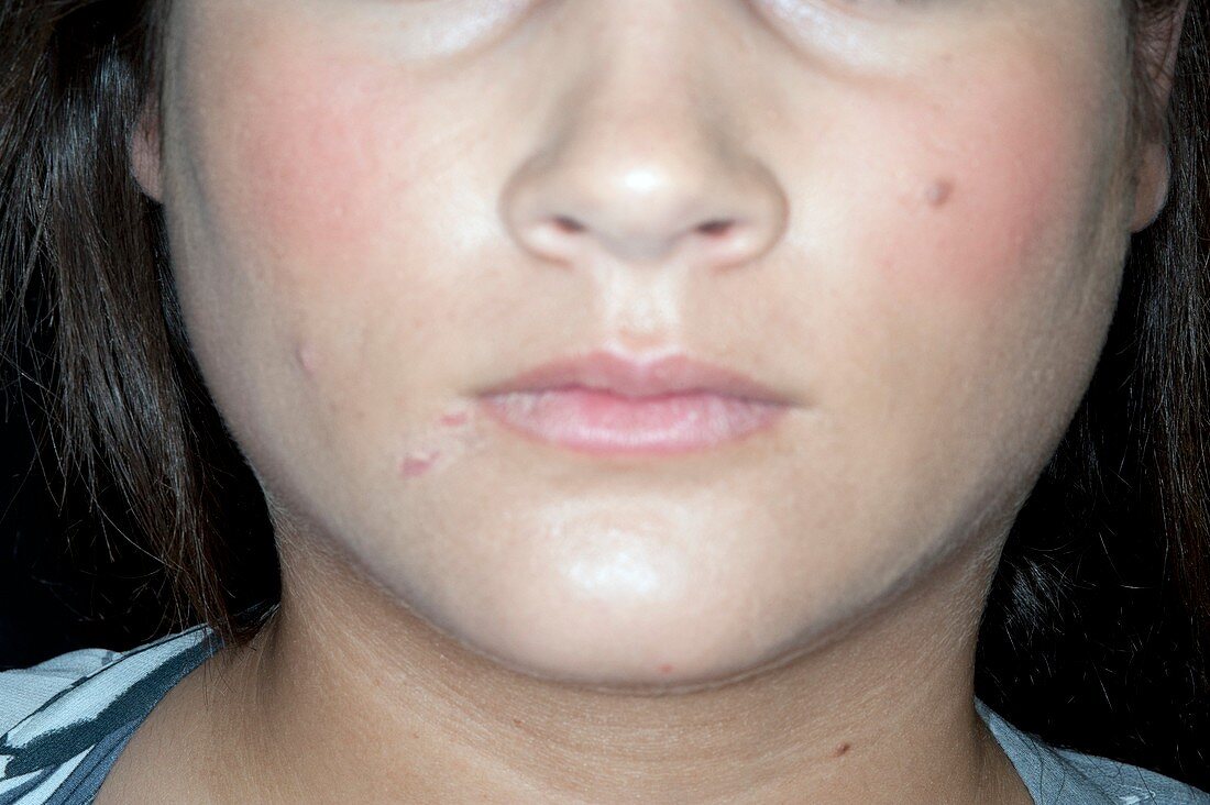 Swollen parotid glands in mumps