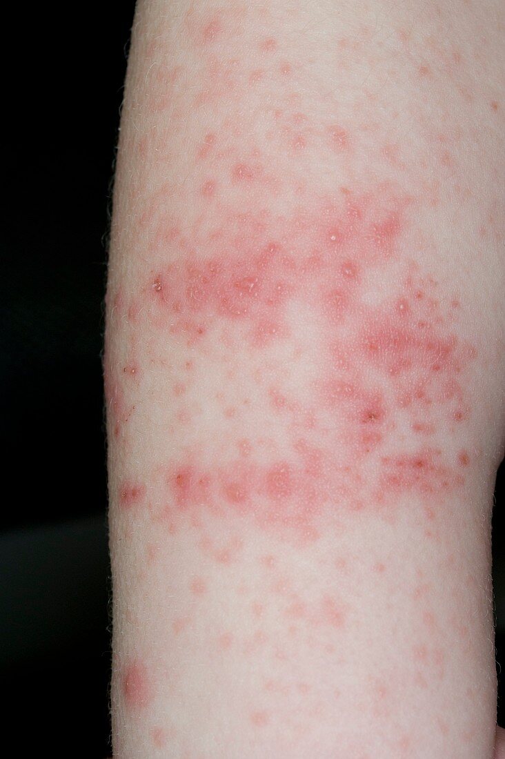 Lesions from hand,foot & mouth disease