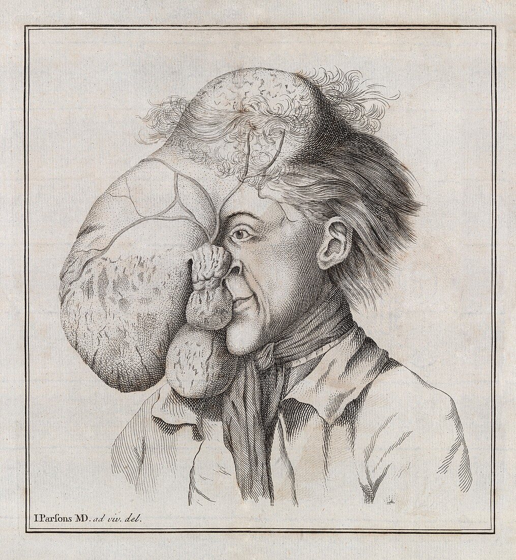 Large tumour of the head,18th century