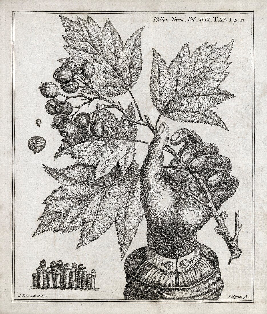 Ichthyosis skin condition,18th century