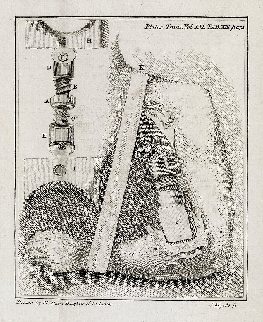 Bone-setting mechanism,18th century