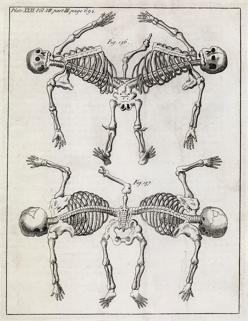 Conjoined twin skeletons,18th century