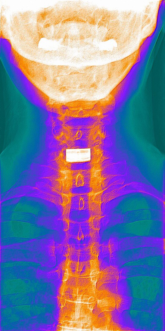 Artificial cervical disc,X-ray
