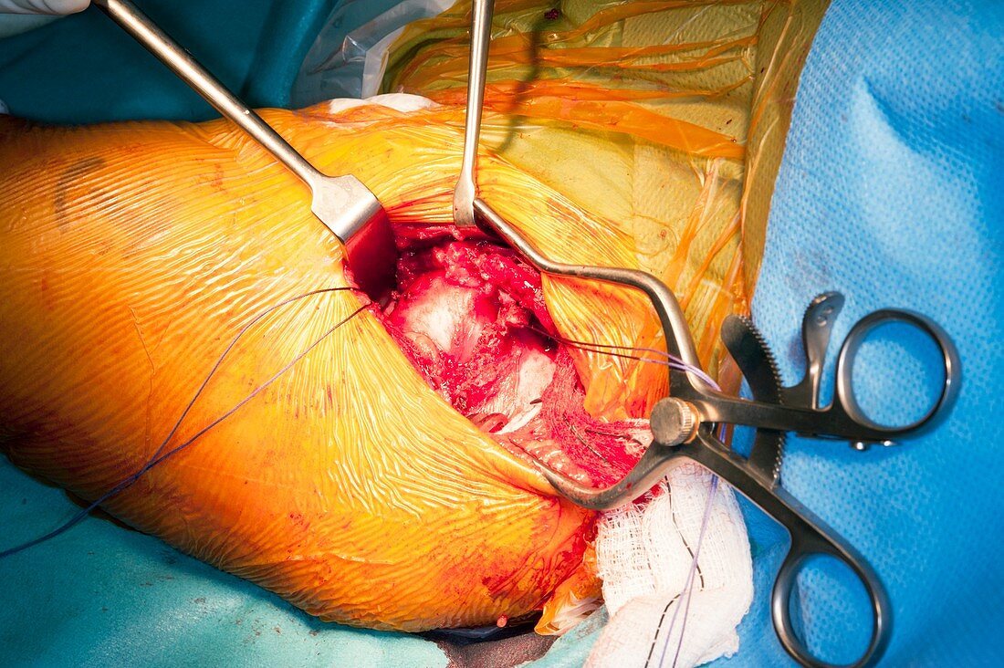 Congenital hip dislocation surgery
