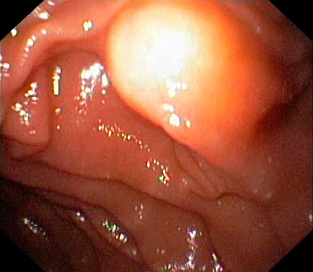 Duodenal lipoma,endoscopic view