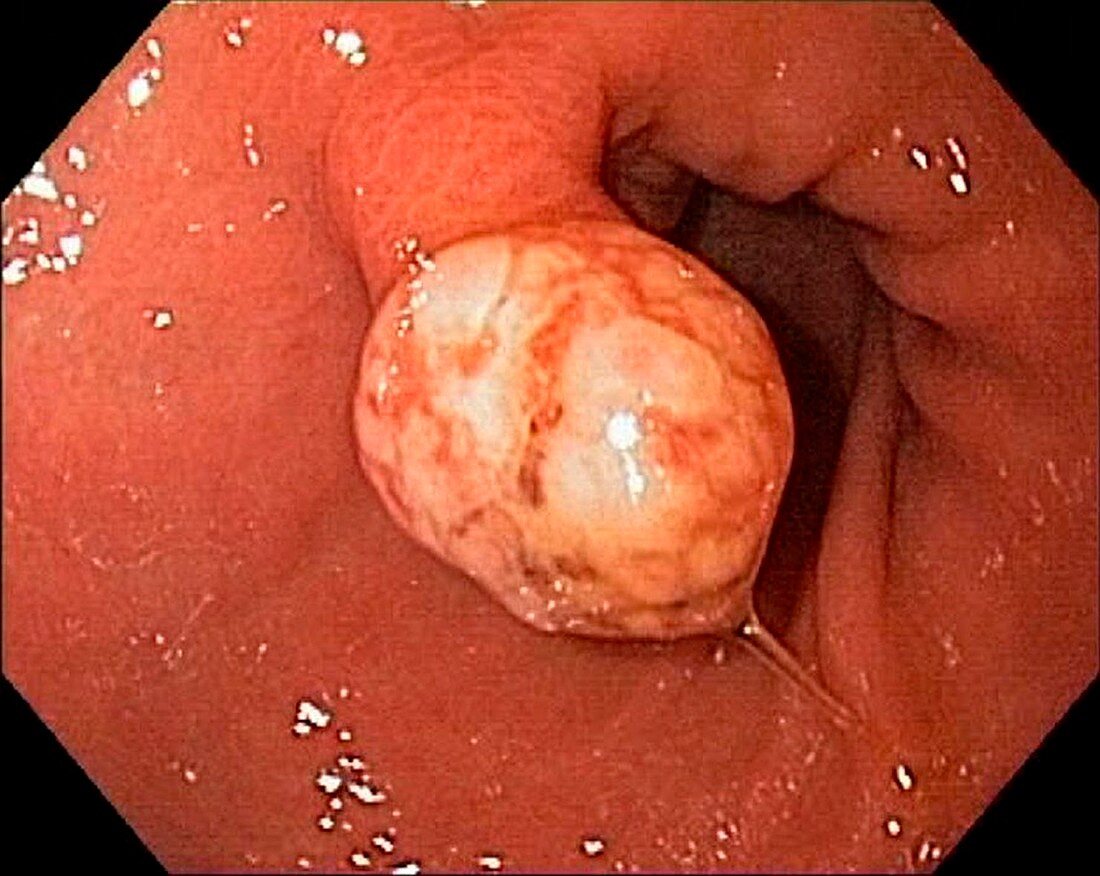 Polyp in the stomach,endoscopic view