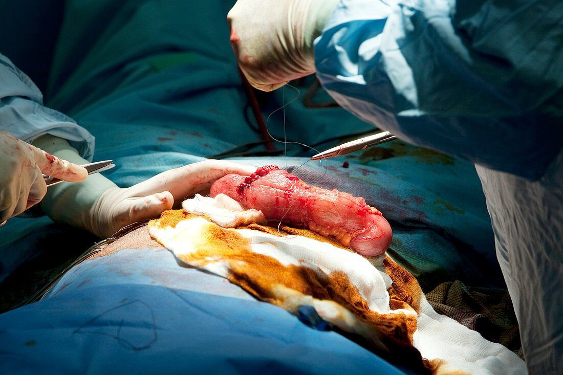 Gall bladder removal surgery