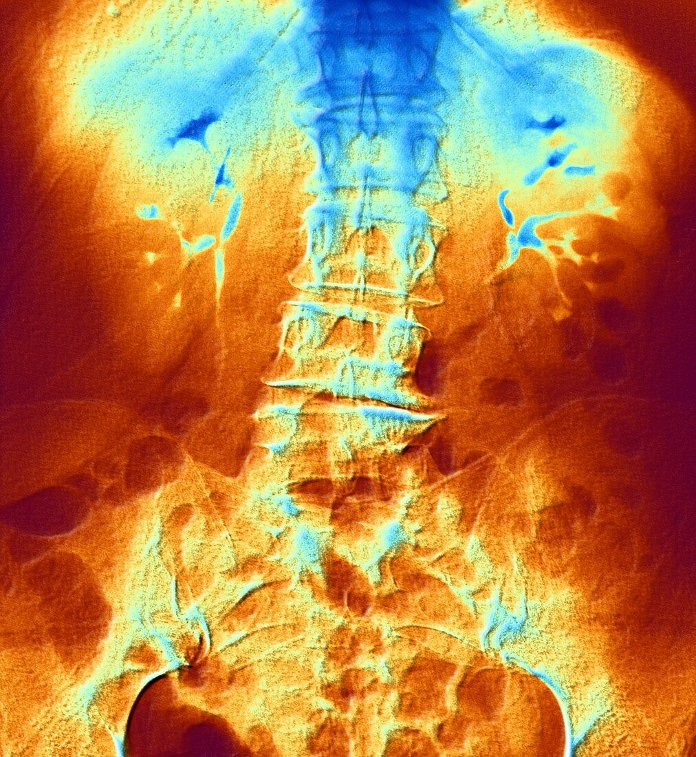 False-col X-ray of lumbar spine of woman