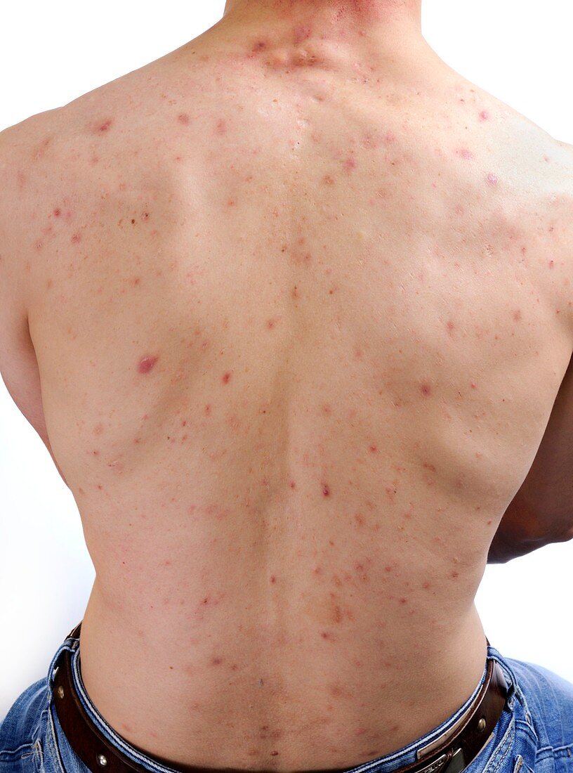 Acne vulgaris on the back