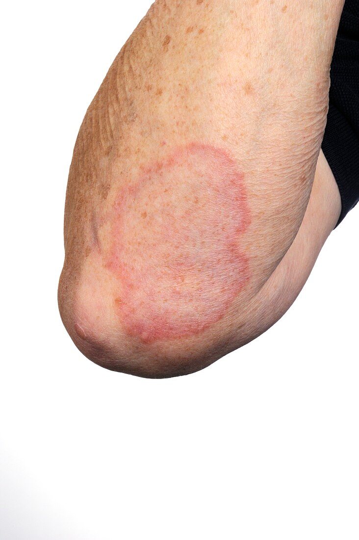 Granuloma annulare on the arm