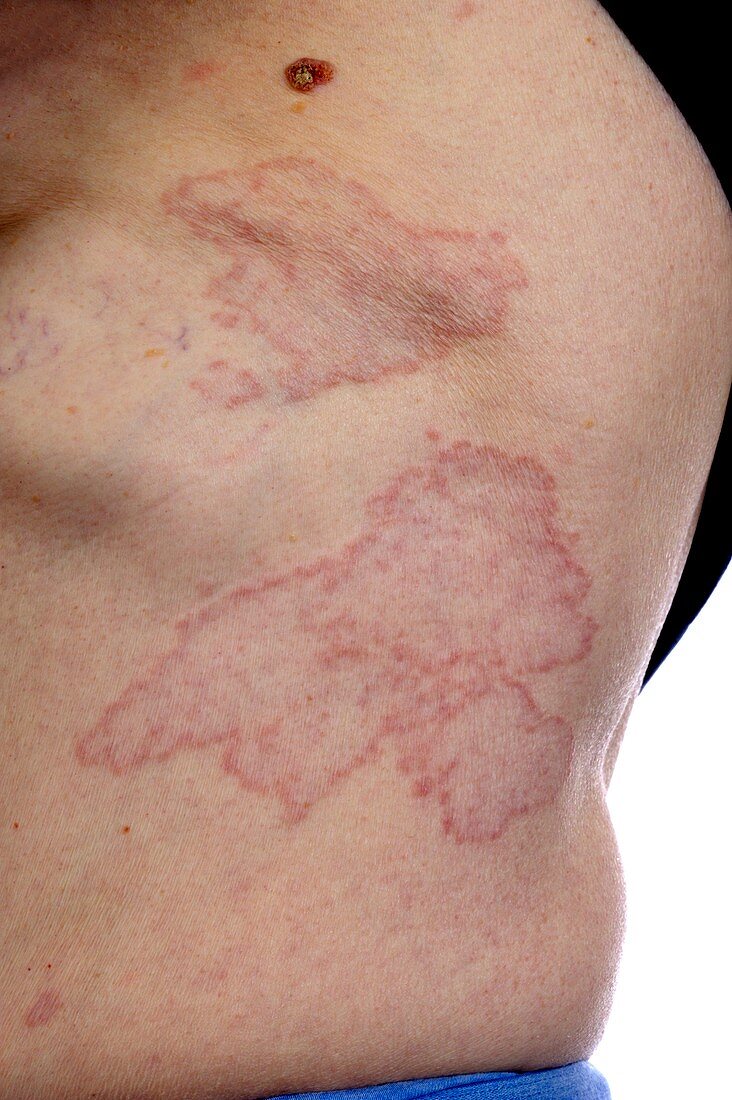 Granuloma annulare on the torso