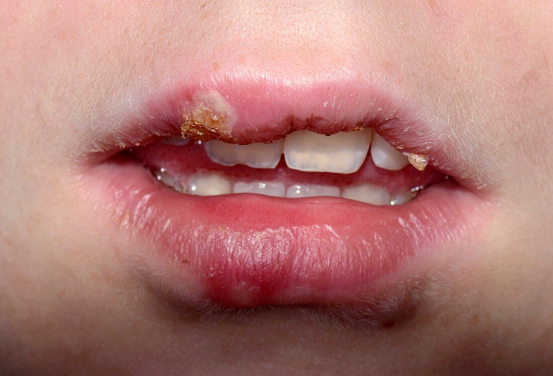 Cold sores on the lip