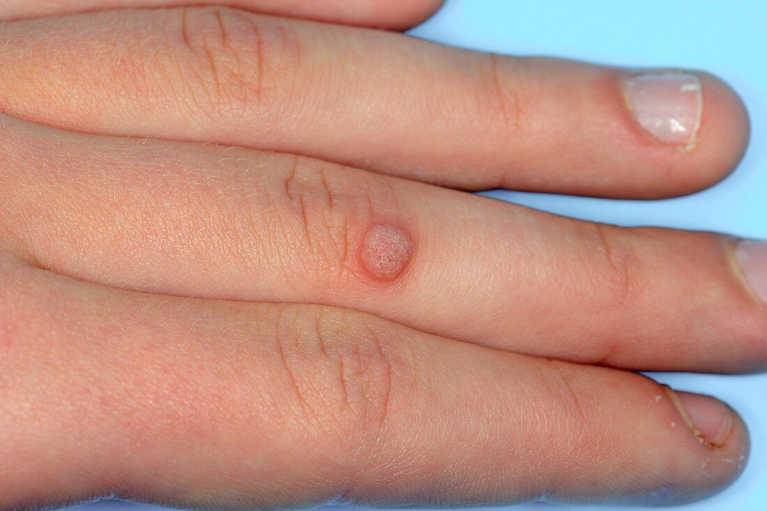 Wart on the finger