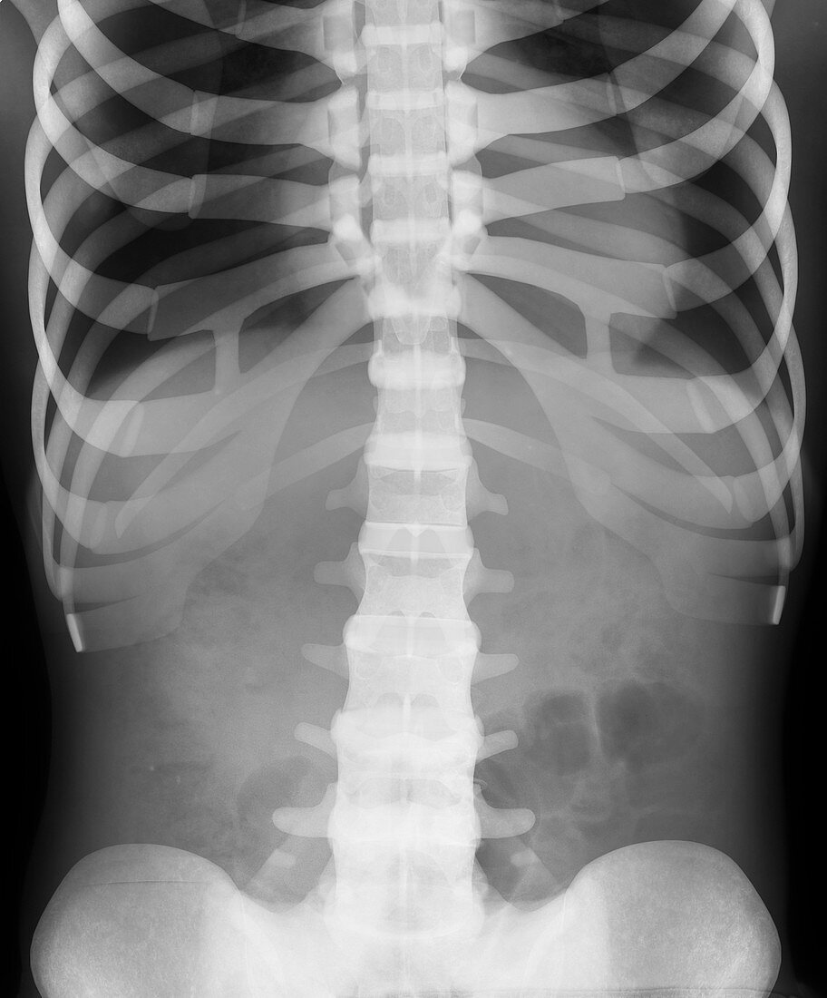 Human thorax,X-ray