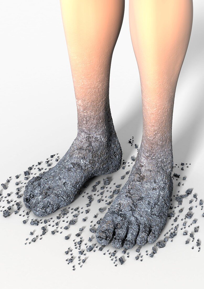 Diabetes-related foot problems,artwork