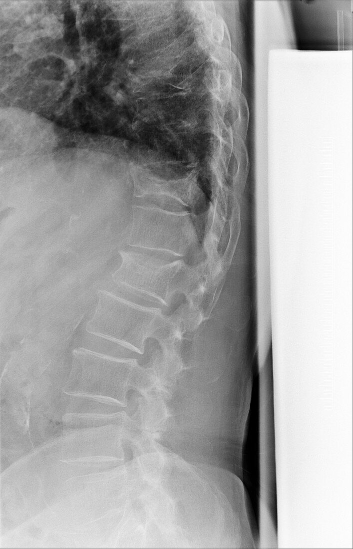 Arthritic spine,X-ray