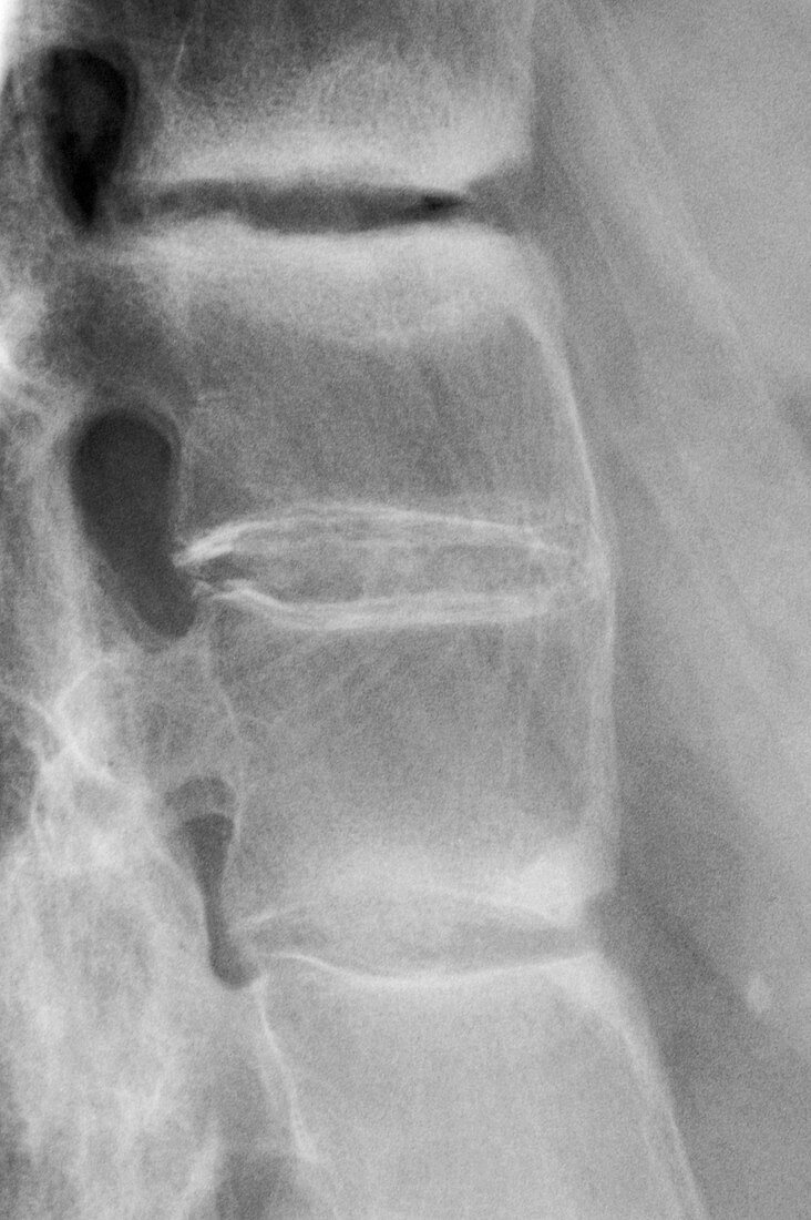 Ankylosing spondylitis,X-ray