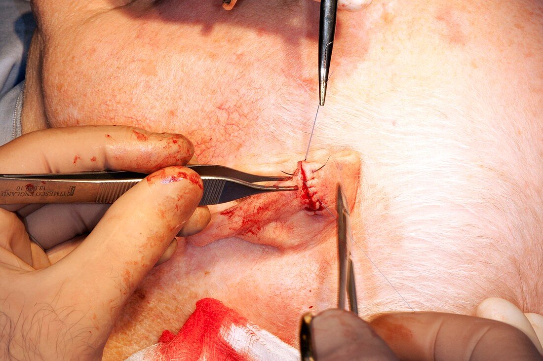 Removing skin cancer from the ear