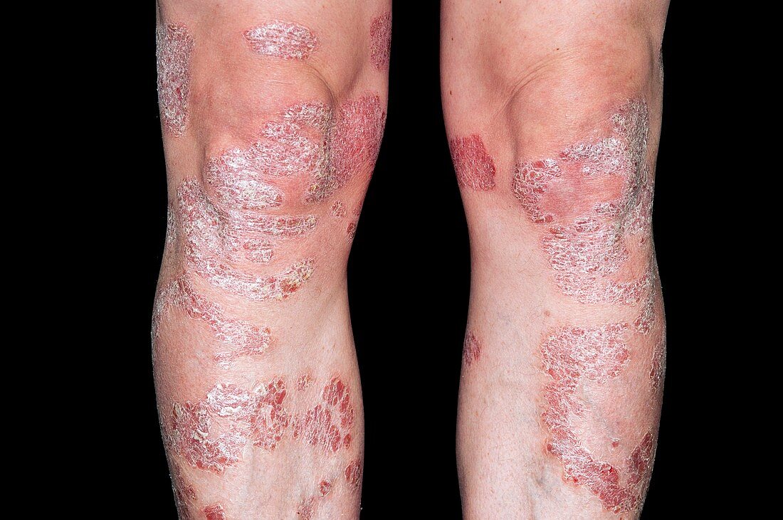 Plaque psoriasis on the legs