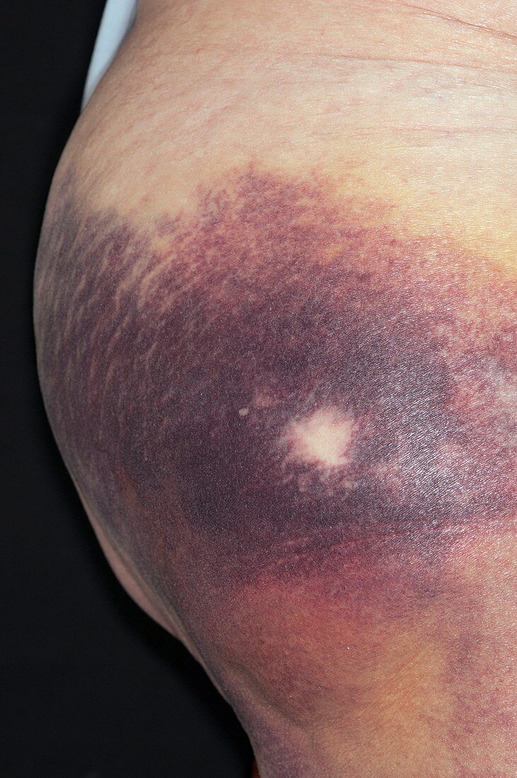 Bruised buttock following a fall