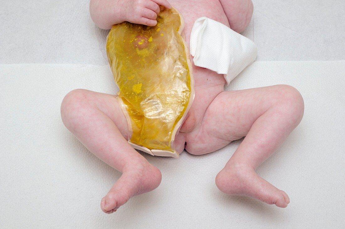 Colostomy in a baby