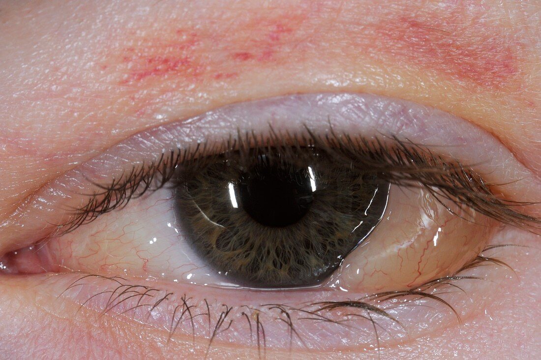Swelling (chemosis) of the conjunctiva