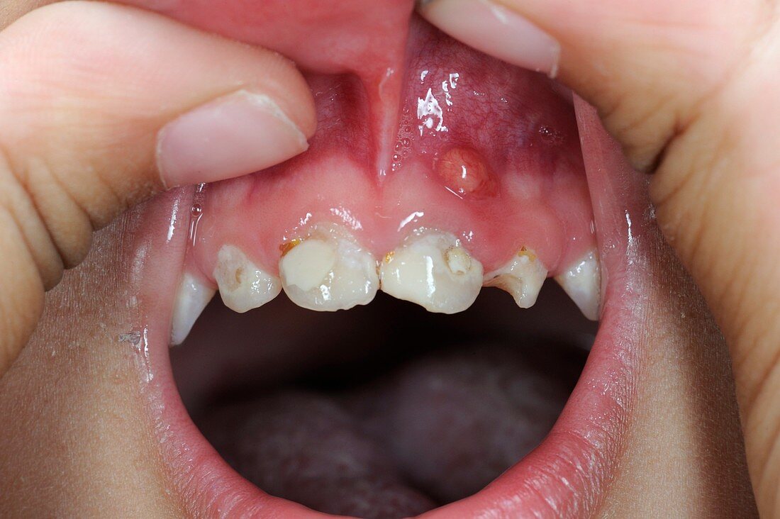 Swollen gum (epulis) and dental fillings