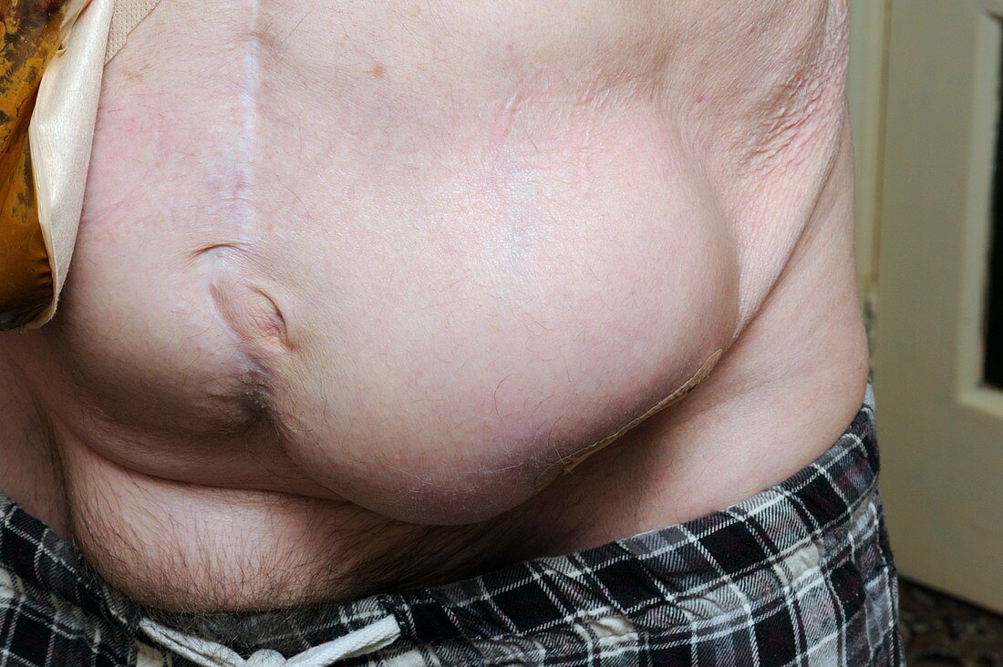 Abdominal hernia and colostomy