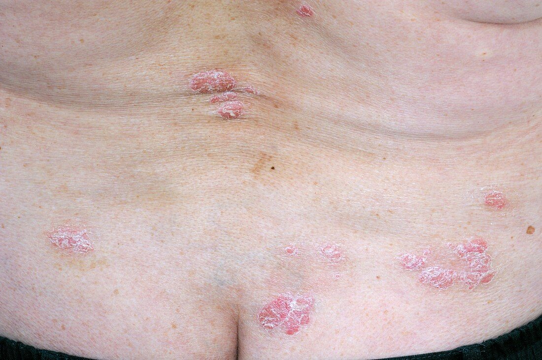 Psoriasis on the lower back