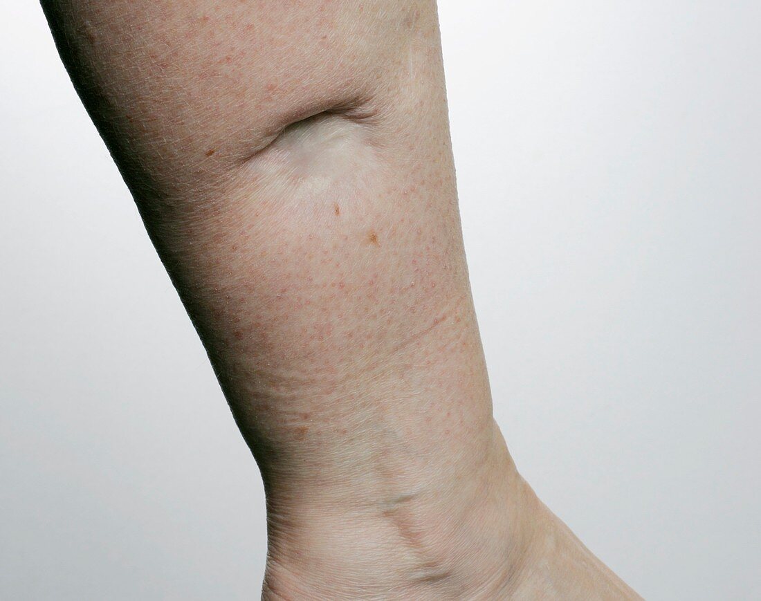 Scar after skin cancer removal