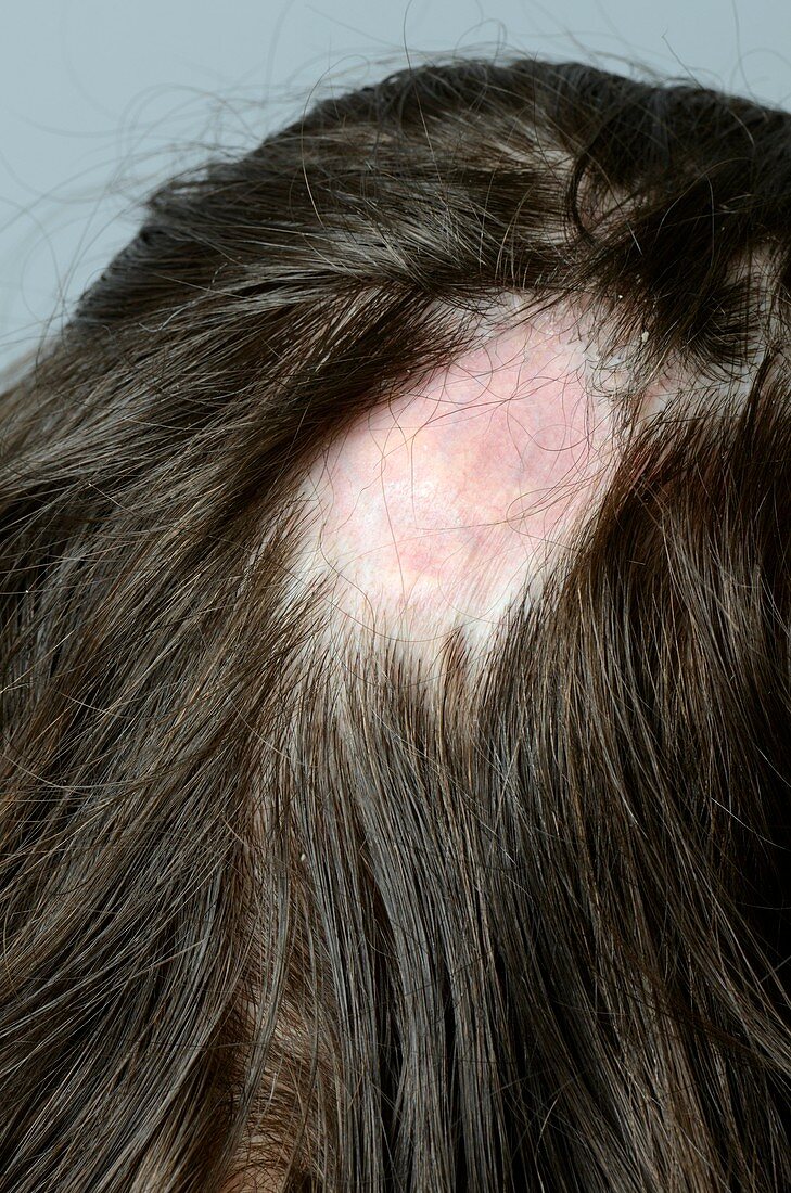 Scarring alopecia (hair loss)
