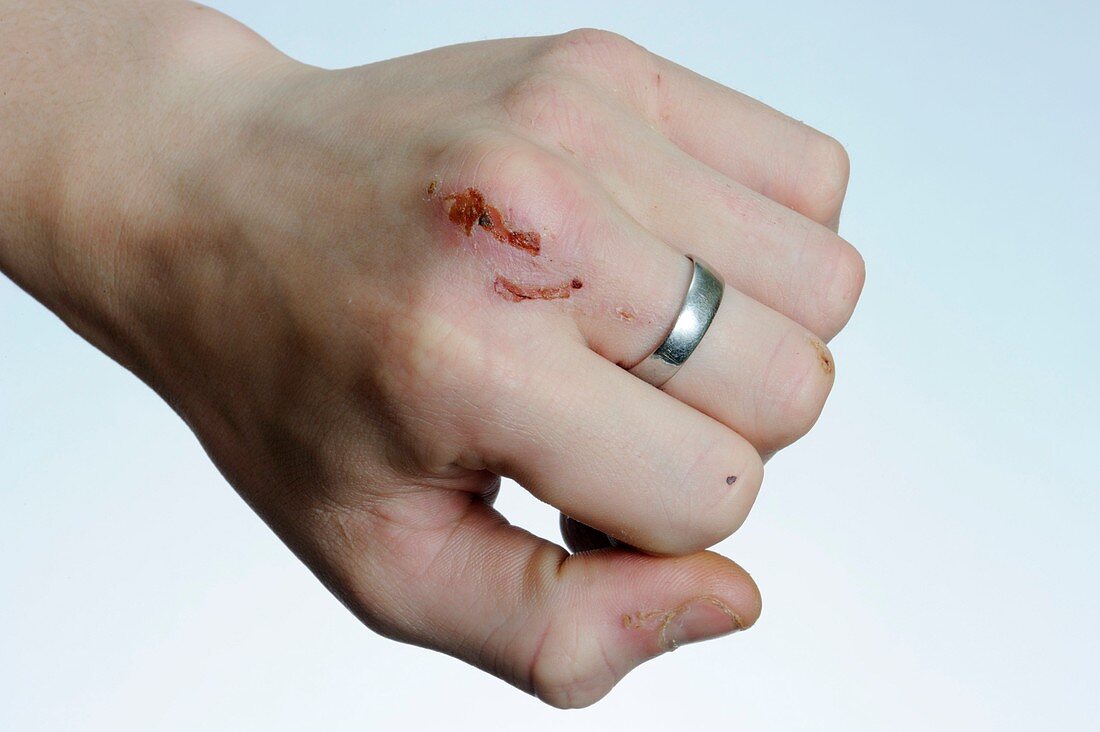 Scars from self harm on the hand