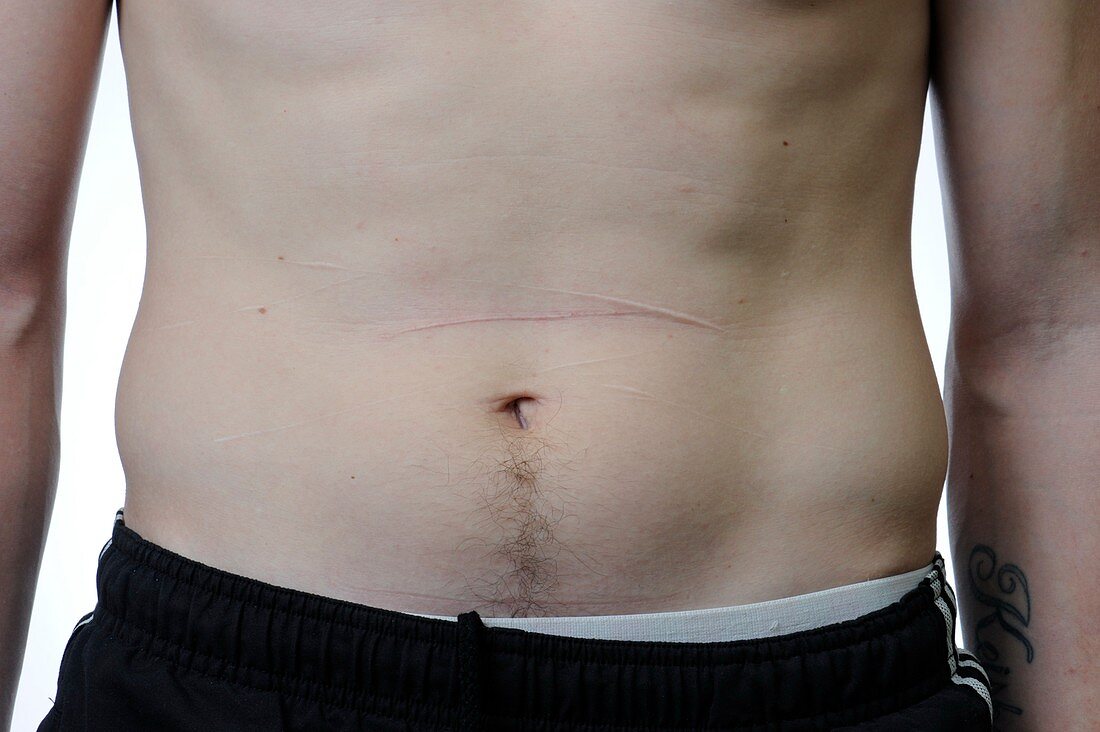 Scars from self harm on the abdomen