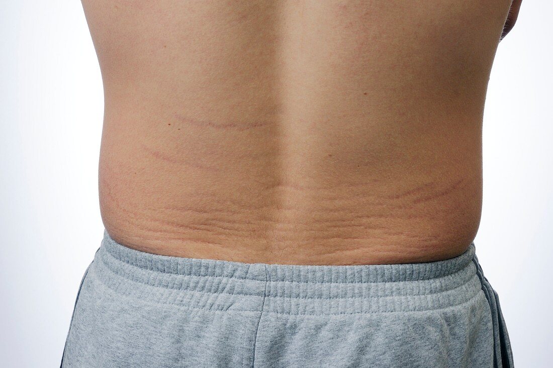 Skin striae (lines) on the back