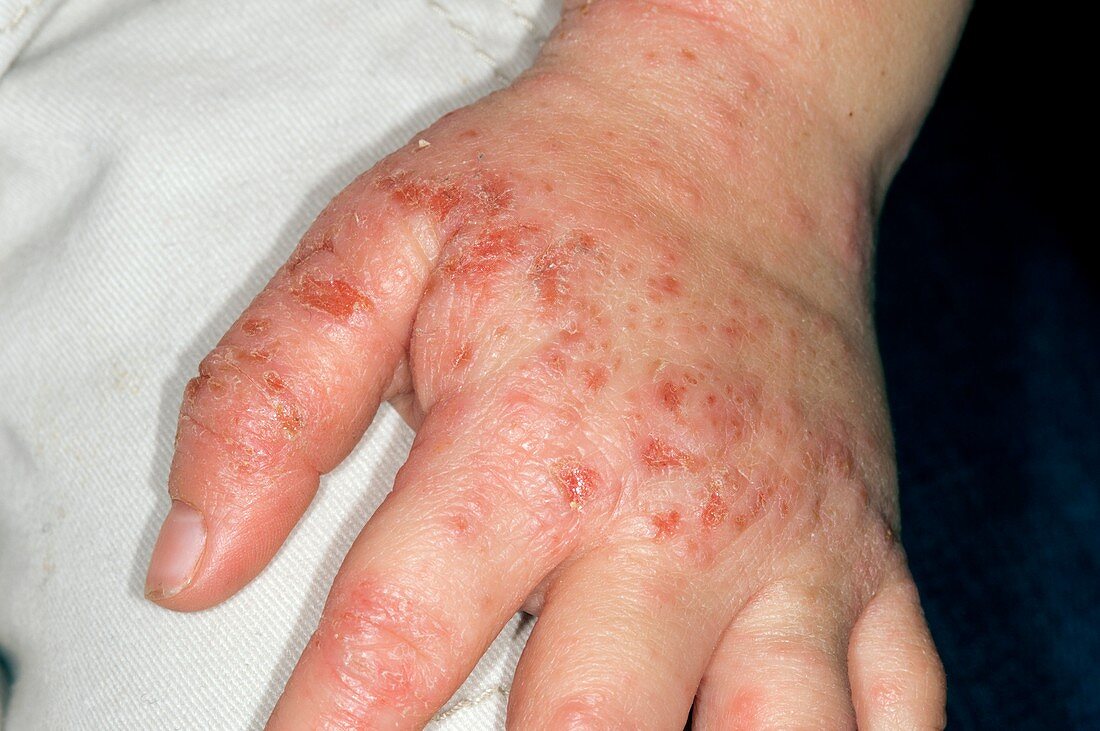 Infected atopic eczema on the hand