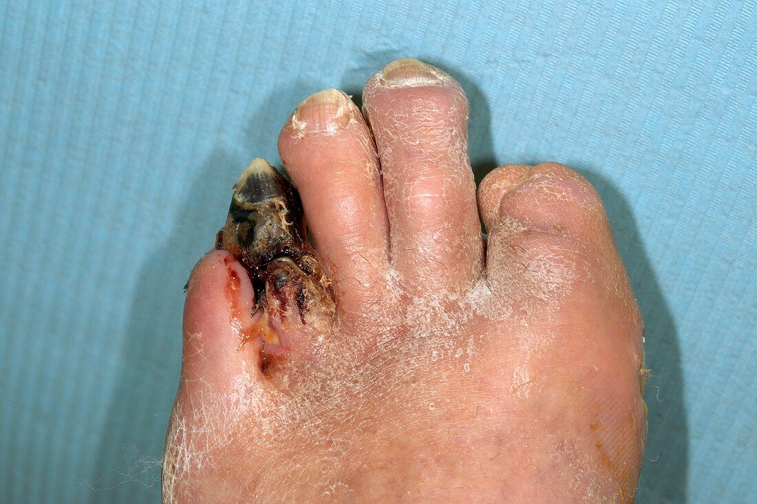 Gangrenous toe in a diabetic