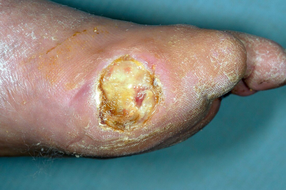 Diabetic foot ulcer with amputation