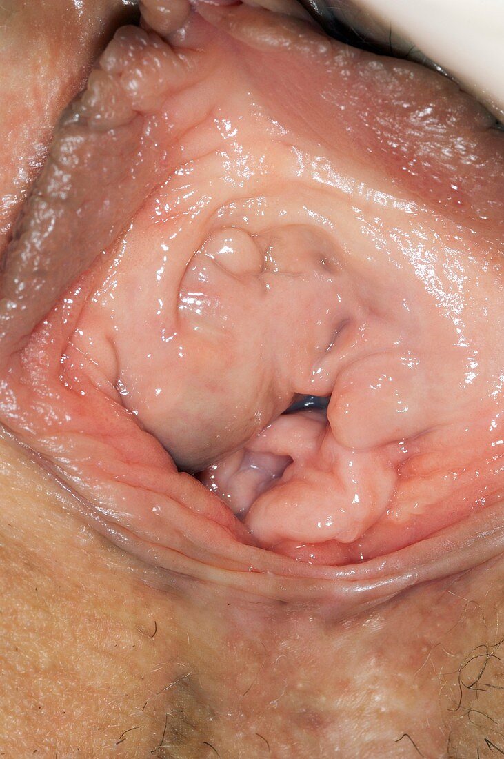 Bartholin's cyst in the vagina