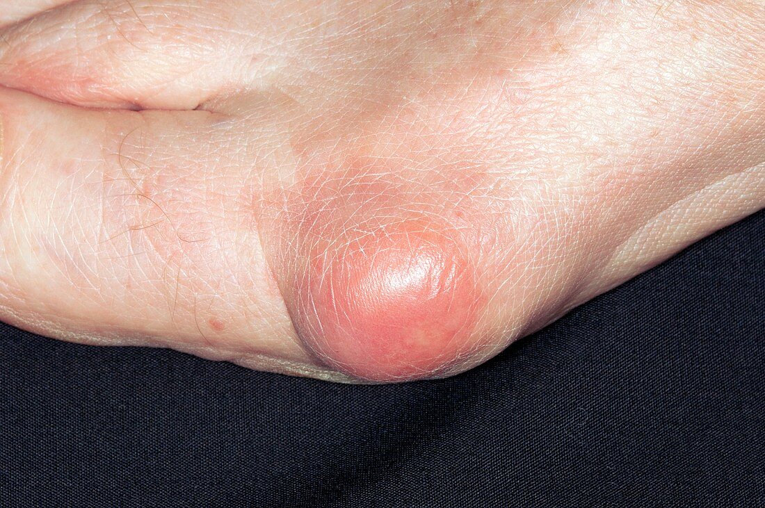 Inflamed bunion