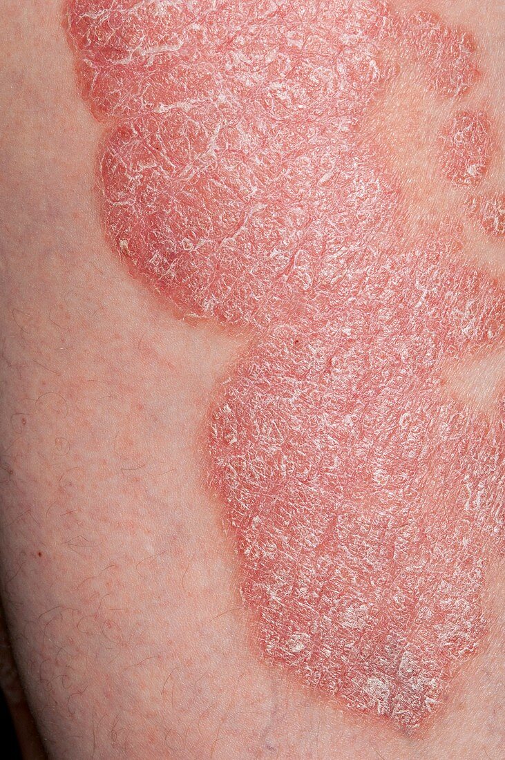 Plaque psoriasis on the skin