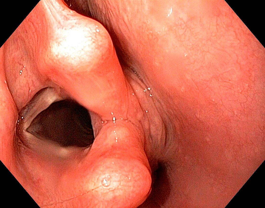 Healthy larynx