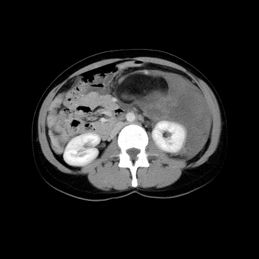 Liposarcoma,MRI scan